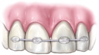 Knocked-Out (Avulsed) Teeth 2