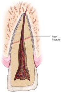 Root Fractures