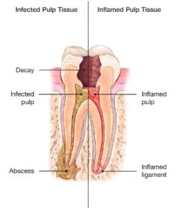 Root Canal Therapy in Pittsburgh, PA - Three Rivers Endodontics