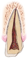 Cracked Tooth Diagram 2