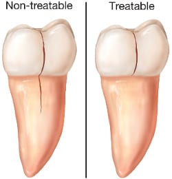 Cracked Tooth