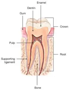 Cracked Tooth Diagram 1