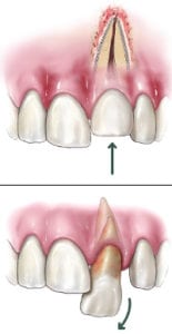 Dislodged (Luxated) Teeth