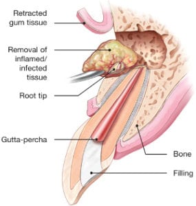 Endodontic Surgery in Pittsburgh, PA - Three Rivers Endodontics